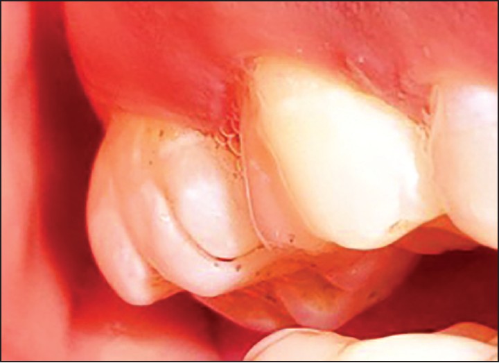 Figure 2: Additional cusp on 17 separated from the tooth by a straight groove