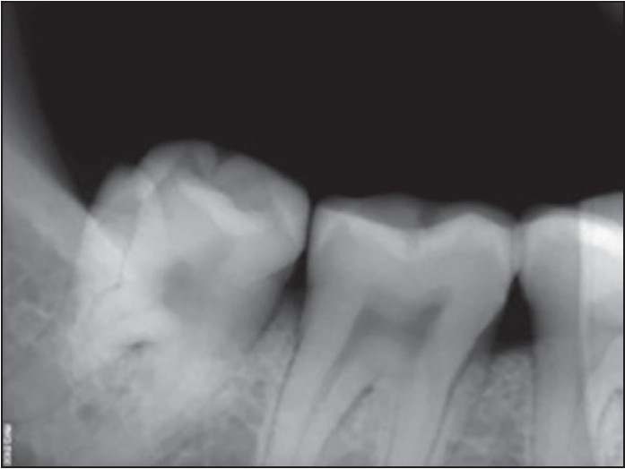 Figure 5: Protostylid on 38 with a rudimentary root