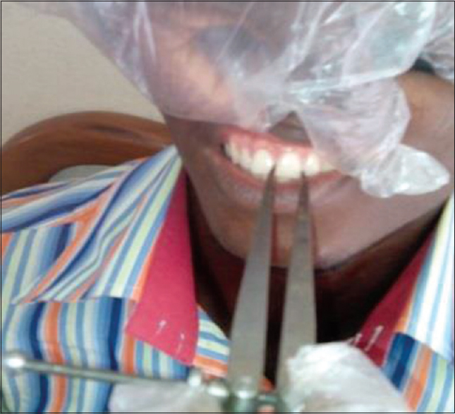 Figure 5: Measurement of central incisor