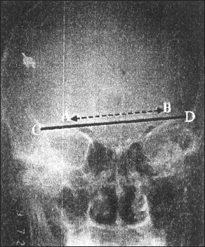 Figure 2: A plate showing land-marks for measurement of width /AB/ of frontal sinus. A = left lateral edge of frontal Sinus. B = Right lateral edge of frontal, /CD/ = Baseline