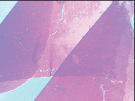 Figure 3: Fold artifact in a section of the liver, ×40