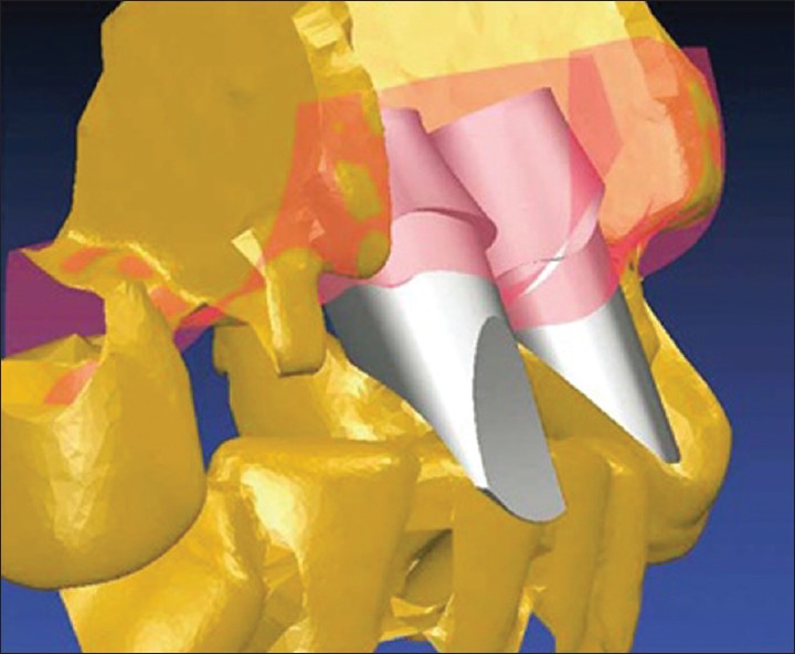 Figure 13: Patient specifi c fi nal abutments are created virtually on a
computer monitor