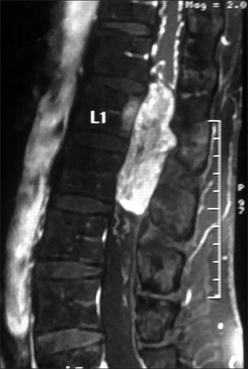 Figure 3: T1W saggital post contrast