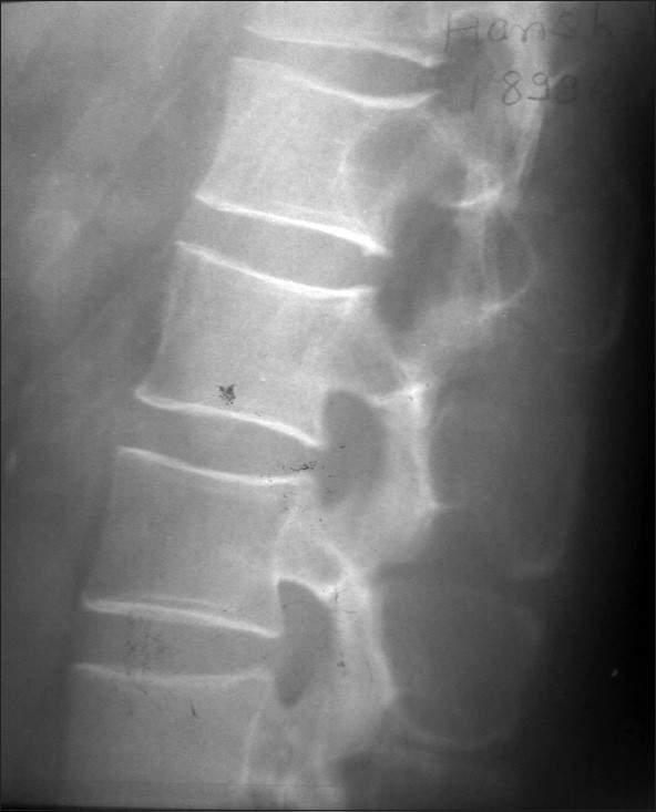 Figure 4: X‑ray of the Dorso‑lumbar region showing significant
scalloping of posterior margin of L1 vertebral bodies and their posterior
elements