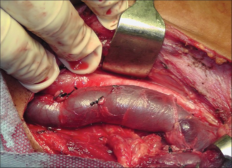 Figure 2: Intraoperative photograph showing dilated internal jugular vein