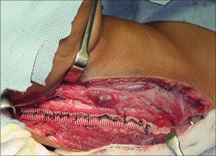 Figure 3: Right internal jugular vein wrapped in an 8-mm PTFE tube graft