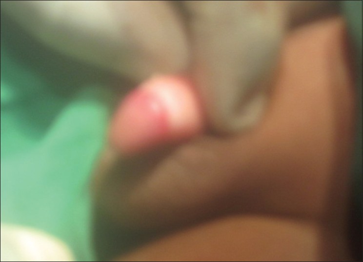 Figure 2: Glans penis freed and prepuce everted
