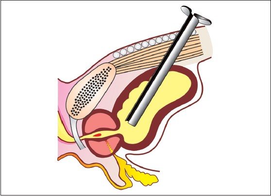 Figure 2: Tilting of suprapubic cystostomy trocar cranially due to collapsing bladder following gush of urine outward