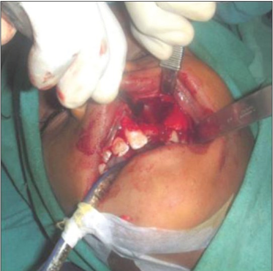 Figure 4: Surgical view after complete cyst enucleation