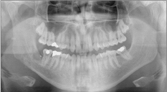 Figure 3: Panorex view of the mandible