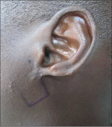 Figure 2: Design of the Limberg flap