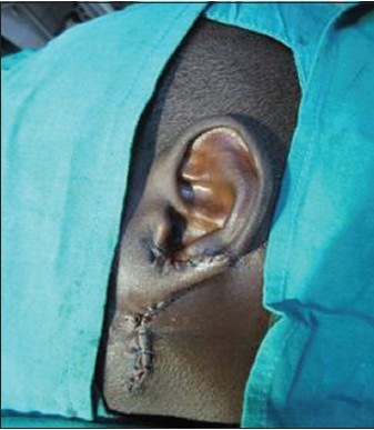 Figure 5: Flaps sutured and secondary defect is closed by direct approximation